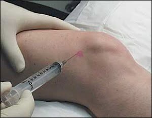 Steroid shot needle
